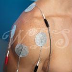 Does Using a TENS Unit for Weight Loss Help?