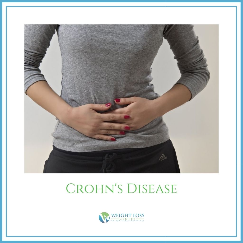 Crohn's Disease