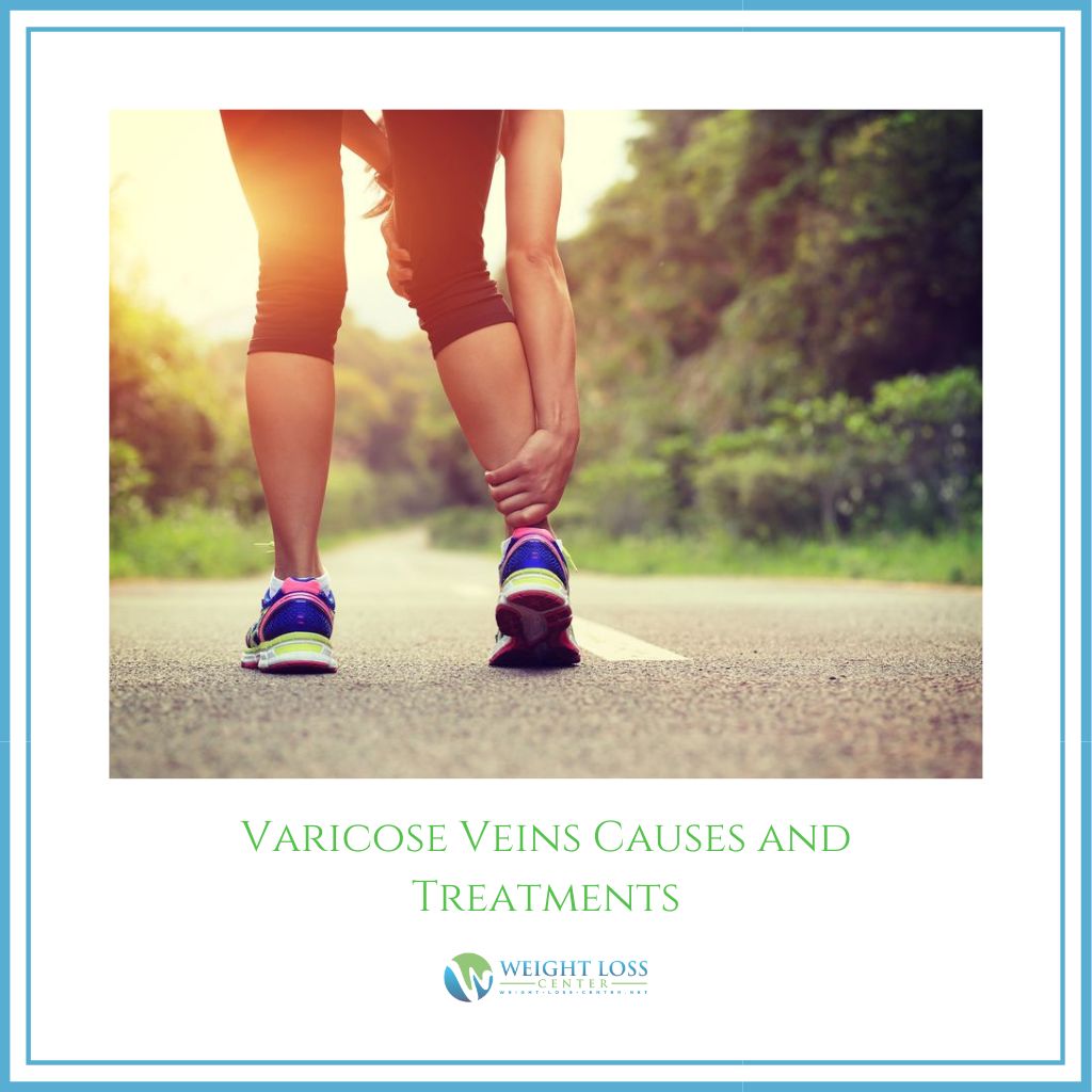 Varicose Veins Causes