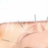 Can Acupuncture Get Your Hormones in Balance?