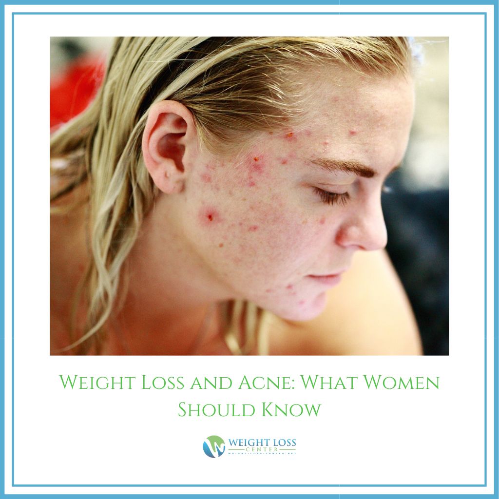Weight Loss and Acne